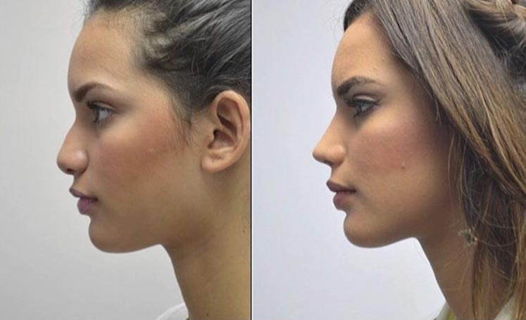 Turkey Rebirth with Nose Revision