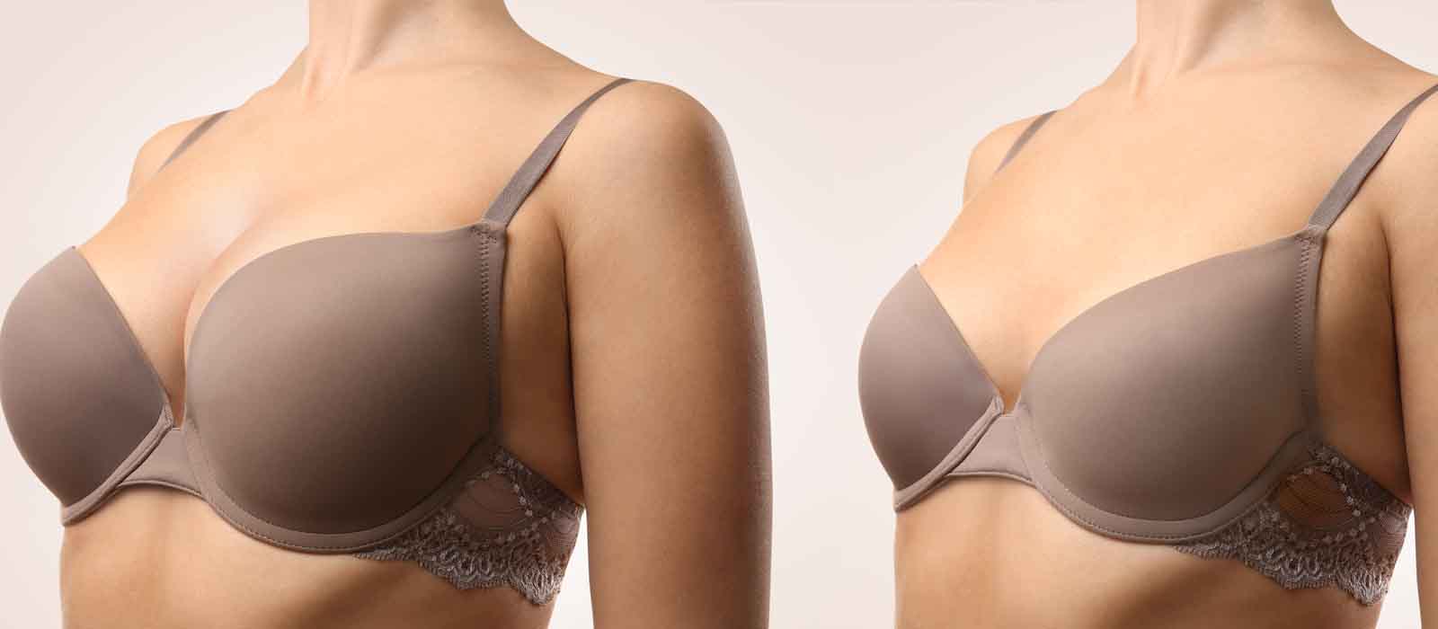 Tips About Breast Reduction Surgery