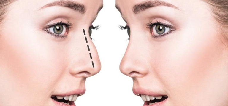 Non-Surgical Rhinoplasty For Fast Beauty