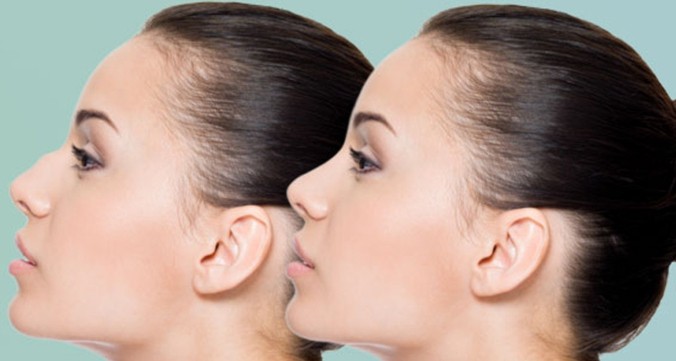 hizmet Non-surgical miracles with nasal filler