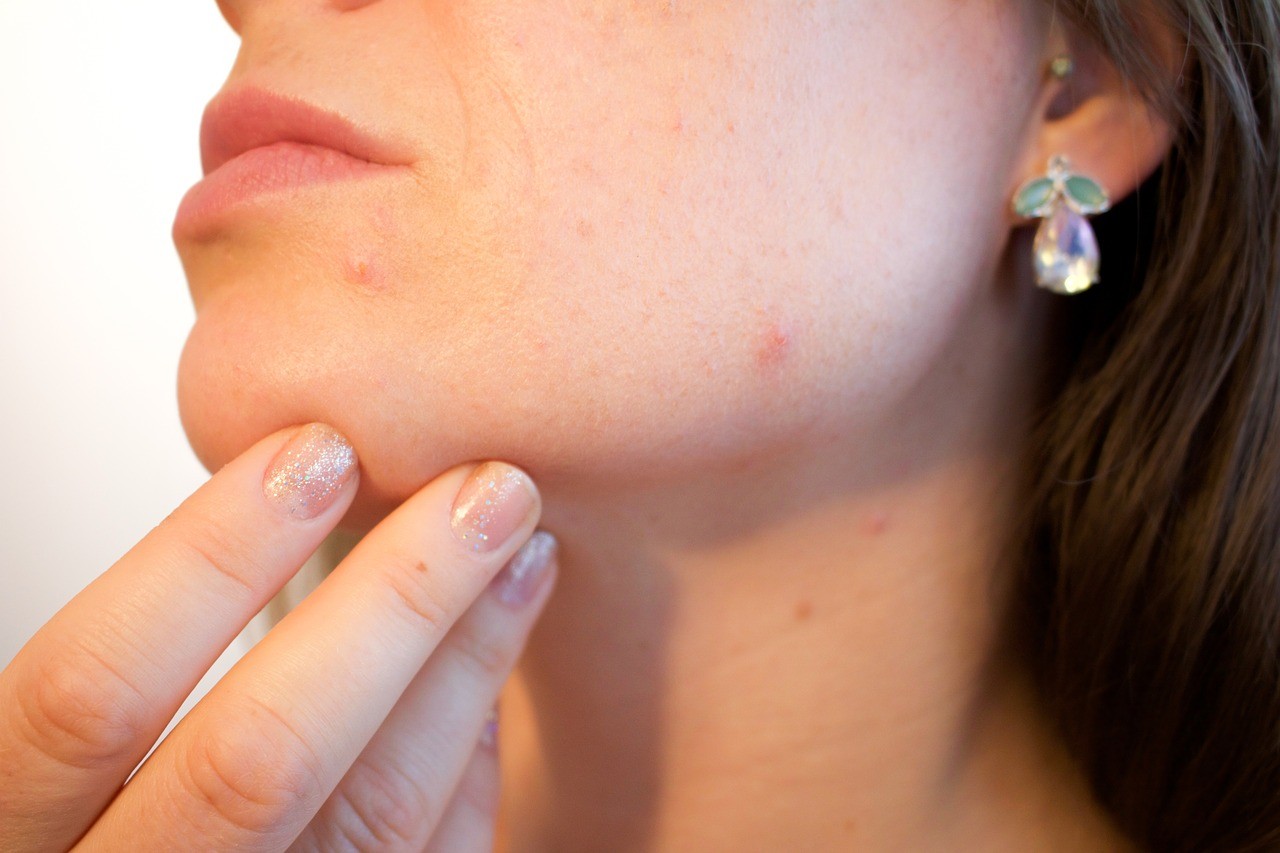 What Is Agnes Acne Treatment?