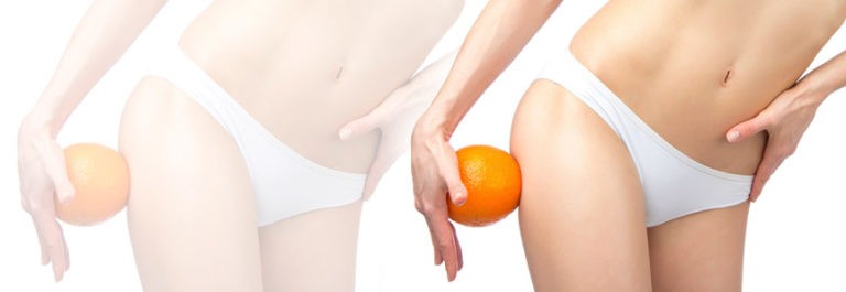 Liposuction Surgery