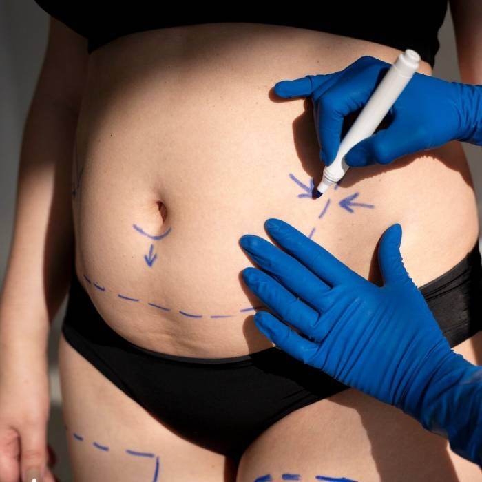 Postpartum Abdominal Aesthetics