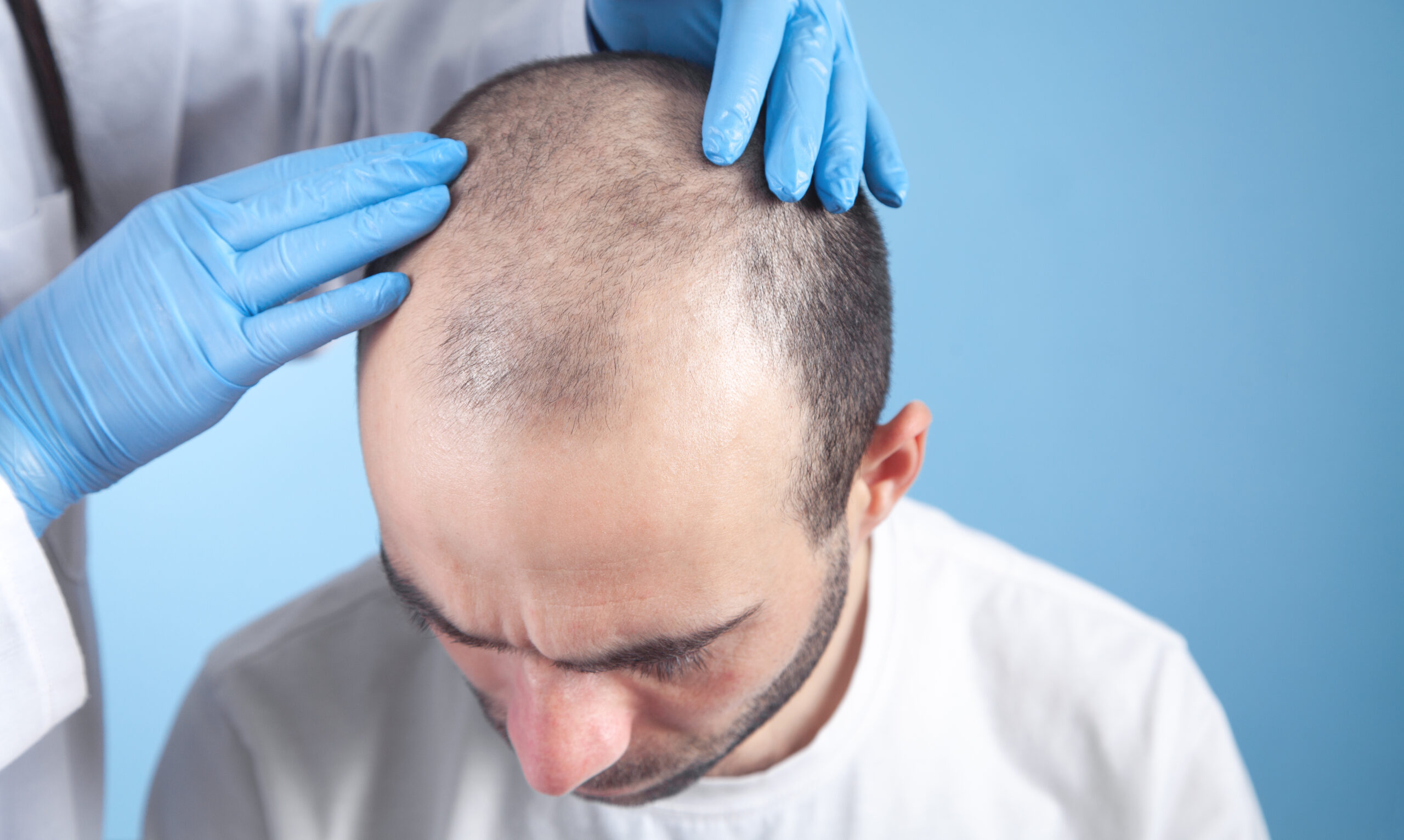 Hair Transplant Prices