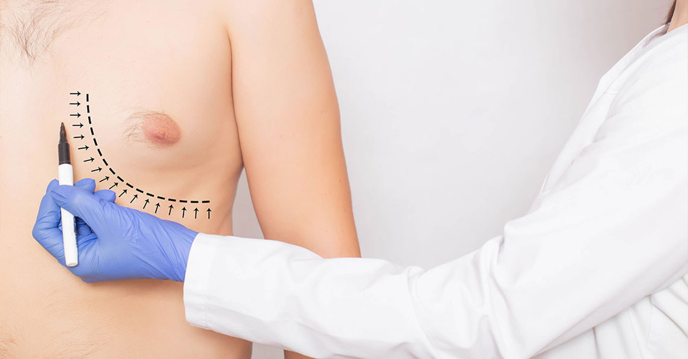 What Is Gynecomastia Surgery and How Is It Performed?