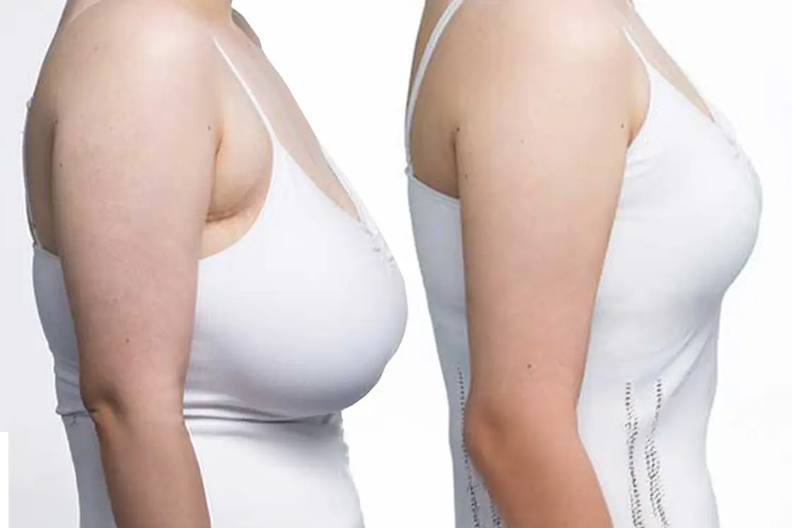 Breast Reduction Surgery Prices 2025