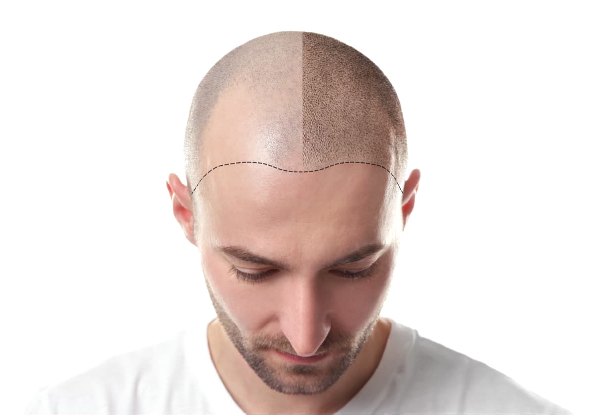 First 6 Months After Hair Transplant: Expectations and Results